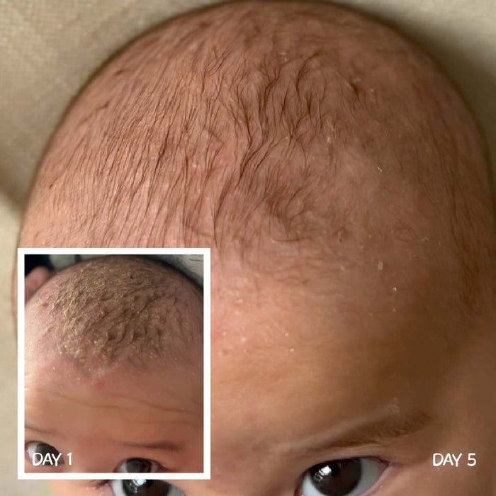 Before and after comparison of scalp texture on a person's head, with 'Day 1' and 'Day 5' insets.