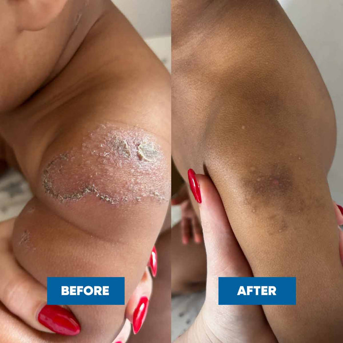 Before and after comparison of a person's knee with visible skin conditions.