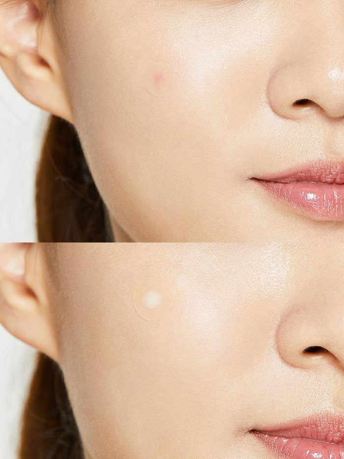 COSRX Acne Pimple Master - 24 patches